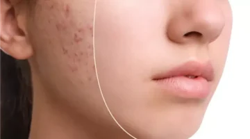 5 أسباب.. أسباب حب الشباب في الثلاثينيات عند السيدات وكيفية التخلص منه بفعالية